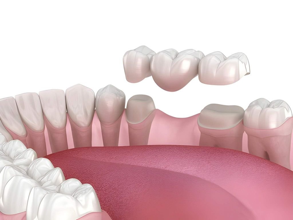 dental bridges in burlington on