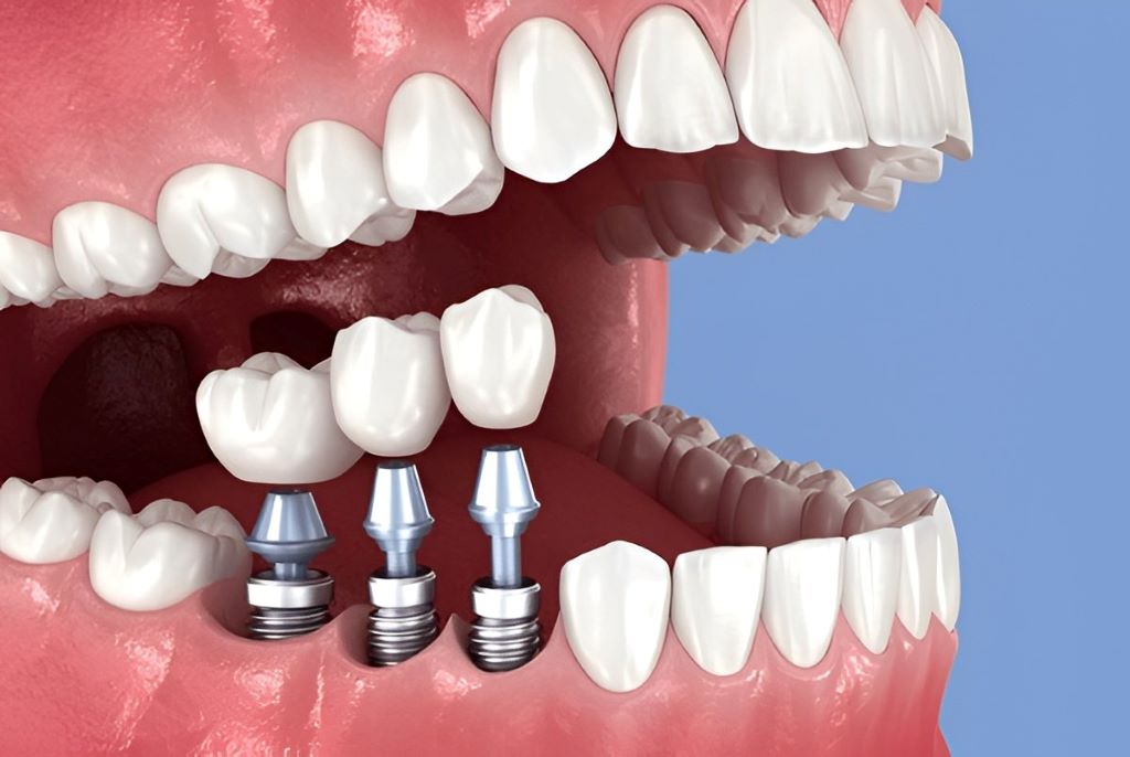 dental implants in burlington on