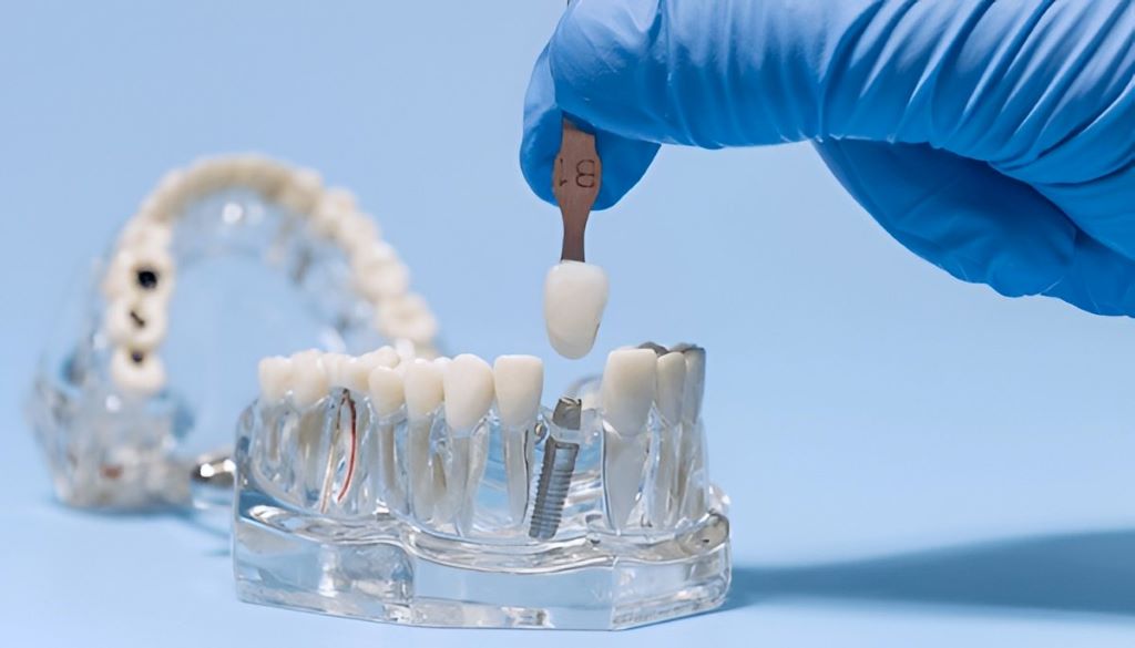 dental implants near you