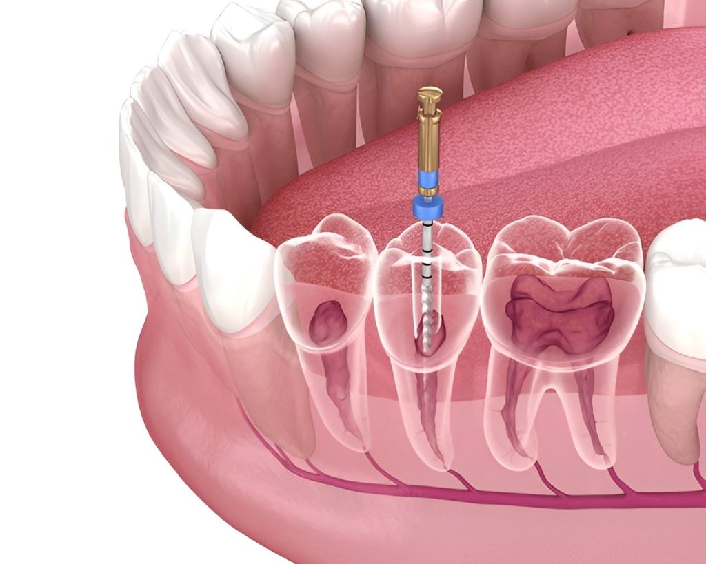 root canal therapy in burlington on