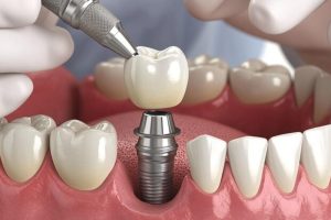The Life-Changing Benefits of Modern Dental Implants