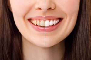 Dentist checking a patient's teeth to see if they are a candidate for whitening